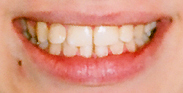 Tratamente ortodontice